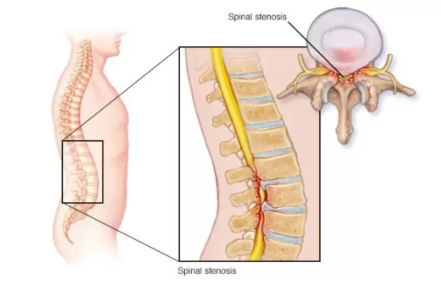 What Is Lumbar Spinal Stenosis